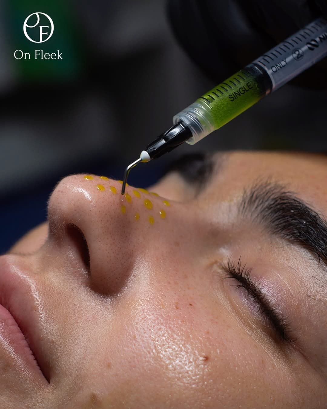Experiencia BioRePeel con On Fleek Skin Center